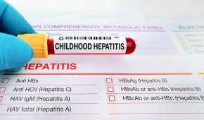 Hasta el momento en México solo se ha registrado una muerte por hepatitis aguda