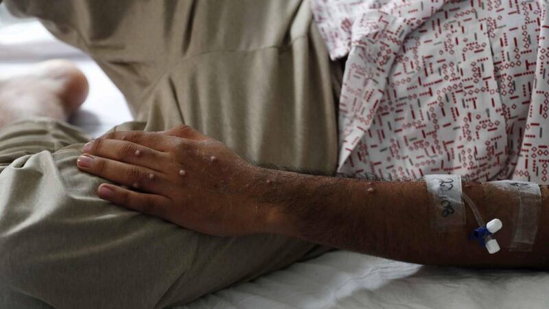 Registra Francia primer contagio de viruela del mono, mpox