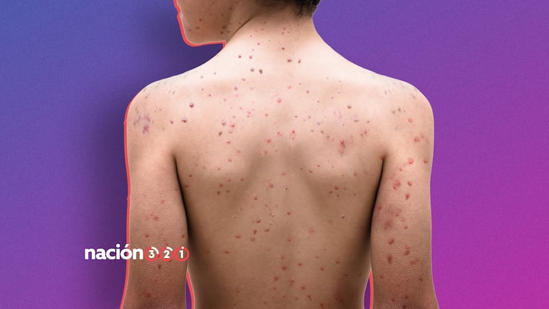 Y a todo esto... ¿qué es el sarampión y cuáles son sus síntomas?