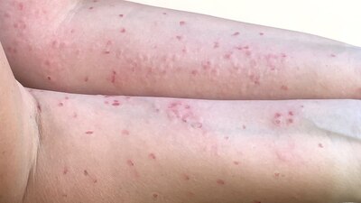 Las autoridades informaron que establecieron cercos sanitarios por los contagios