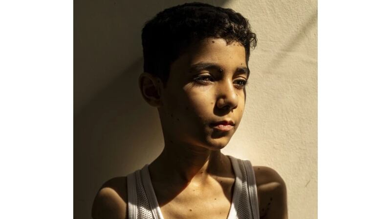 Retrato de niño palestino amputado por la guerra en Gaza es Foto del Año de World Press Photo
