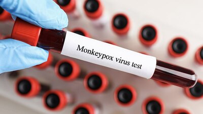 Autoridades sanitarias están preocupadas por el avance en el brote de Mpox