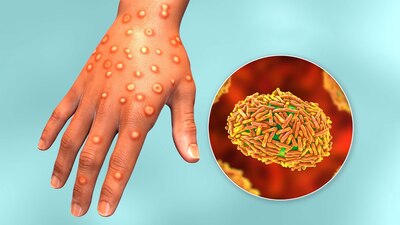 Han aumentado en el país, pues la semana pasada había 147 confirmados