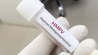Muere paciente con metapneumovirus humano (HMPV) en Puebla