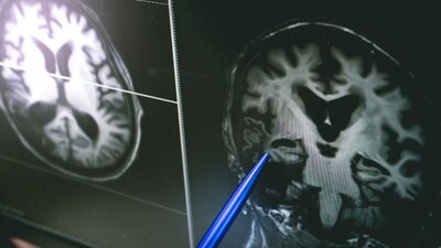 Los infectados por COVID-19 pueden padecer síntomas neurológicos como niebla mental y confusión.