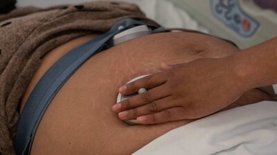 Durante 2021, se registraron 23 mil casos, la mayoría en el parto