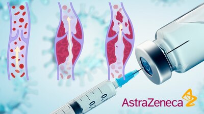 Estos son algunos de los síntomas que causa la vacuna de AstraZeneca contra COVID-19