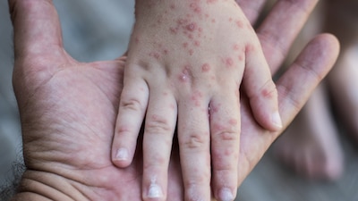 Es un enterovirus que puede causar diversos cuadros inflamatorios