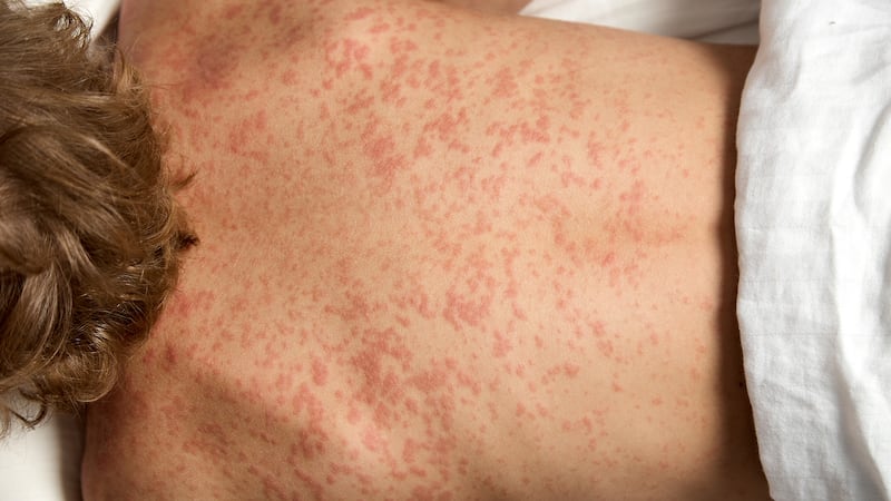 Investigan posible segunda muerte por sarampión en la CDMX; contagios se elevan a 263