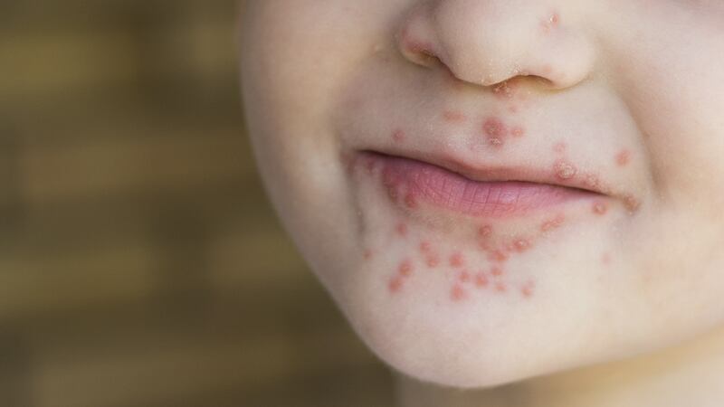 Confirman brote de virus Coxsackie en escuela de Tabasco; hay 20 casos de contagios