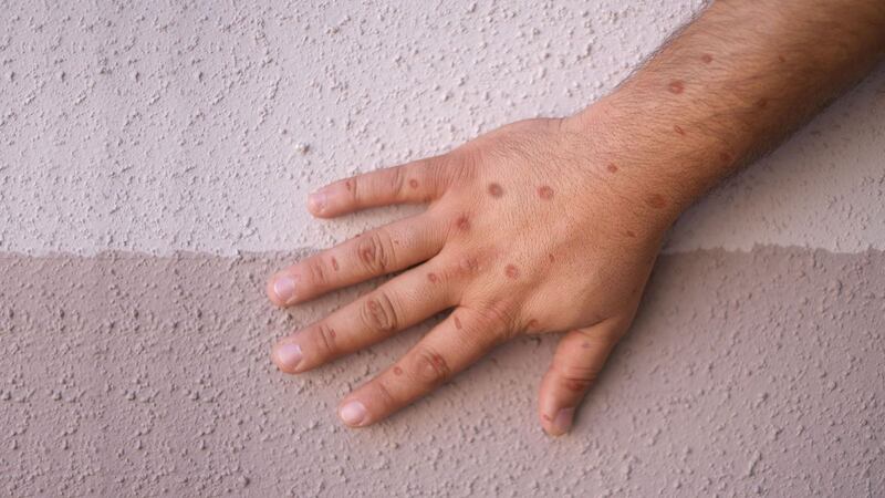 Reportan deceso por viruela símica en Jalisco; paciente tuvo cuadro de neumonía antes de morir