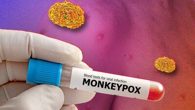 Los contagios a la viruela en México han crecido durante las últimas semanas