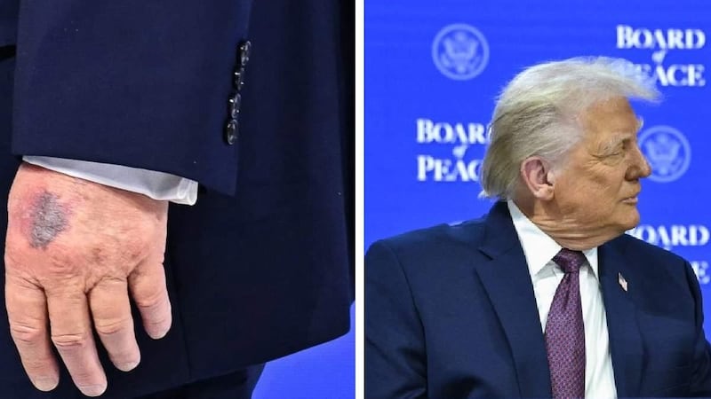 VIDEO: Trump explica la razón por la que tiene un moretón en la mano