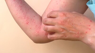 La viruela del mono se expande en todo el país tras la declaratoria de la OMS