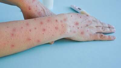 El contagio se habría producido en España según las autoridades sanitarias