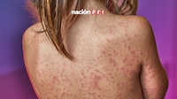 ¿Cómo se contagia el sarampión? Conoce los síntomas de este virus