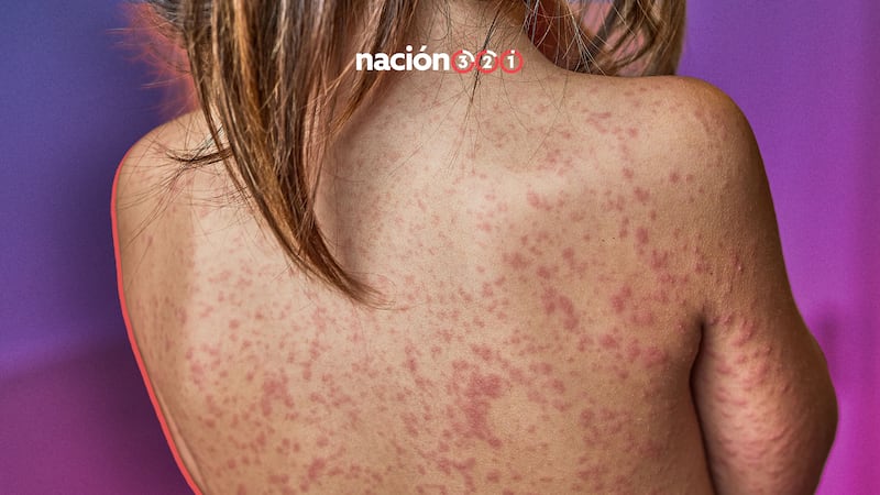 ¿Cómo se contagia el sarampión? Conoce los síntomas de este virus