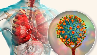 Causa fiebre, cansancio, tos, pérdida del apetito, dolores de cabeza y náuseas