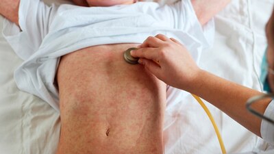 La Ssa alertó a las instituciones médicas para estar evitar que la enfermedad vuelva al país