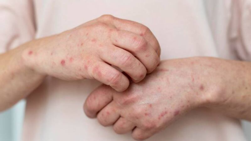 Repuntan contagios de sarampión en Chihuahua: suman 417 casos