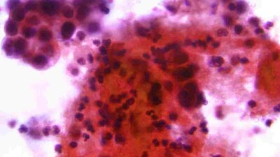 El tratamiento aplicado consistió en la aplicación de inmunoterapia con el fármaco dostarlimab