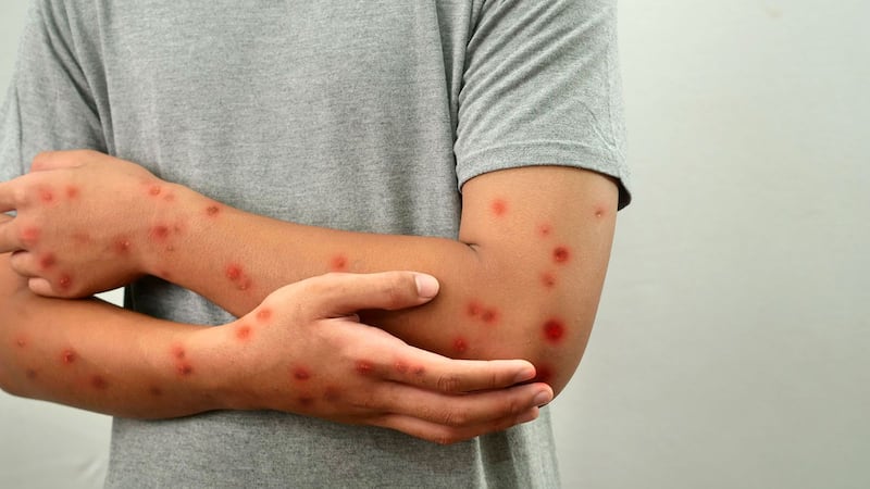 Sarampión sigue presente de forma importante en varios estados de México: Salud