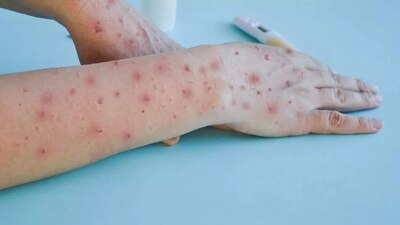 La viruela del mono sigue avanzando en el país, al registrar más de 300 casos