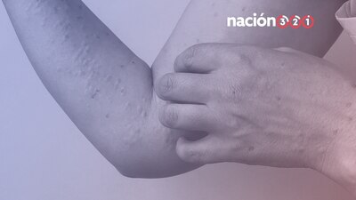 Suman 317 personas infectadas por la viruela del mono en el Área Metropolitana de Guadalajara (AMG)