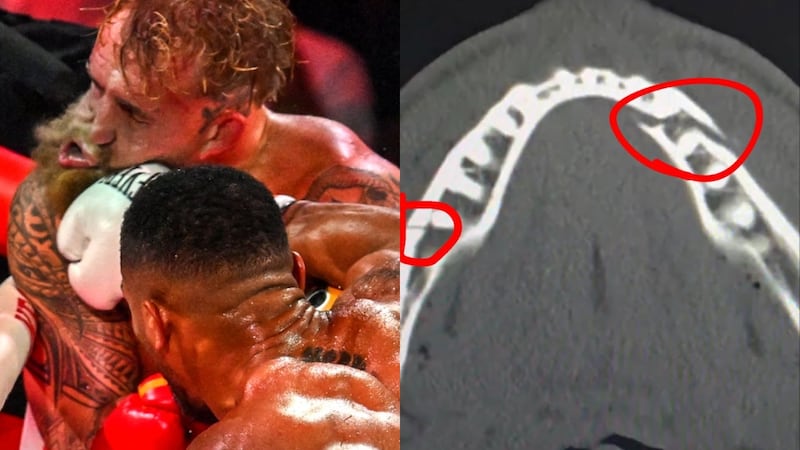 VIDEO: El poderoso golpe con el que el youtuber Jake Paul terminó con doble fractura de mandíbula