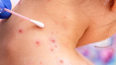 Las dos personas identificadas tienen póstulas en la cara y cuerpo, además de otros síntomas