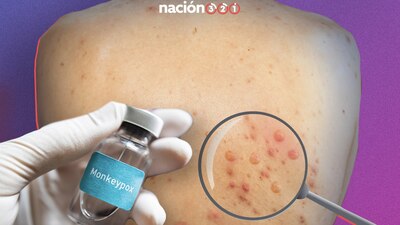 Las complicaciones de la viruela símica son infecciones cutáneas secundarias, neumonía, confusión y problemas oculares.