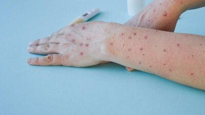 La secretaría de Salud confirmó que el paciente se encuentra estable