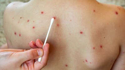 El virus se transmite por diseminación de gotitas o por contacto directo con secreciones