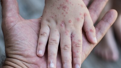 Los niños son los más afectados con esta enfermedad