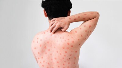 Los contagios han aumentado 30 por ciento de una semana a otra