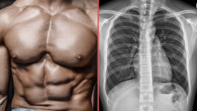 El hombre fue intervenido tras tomarle una radiografía que mostró obstrucción intestinal