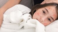 Detectan 21 casos de sarampión en México; emiten aviso epidemiológico