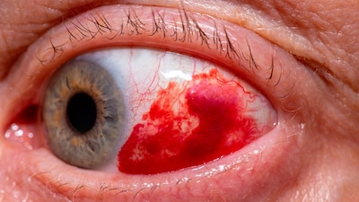 El paciente presentó un cuadro grave de conjuntivitis