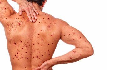 Las personas enfermas pueden contagiar desde que inician síntomas, hasta que todas las lesiones de su piel sean cicatrices