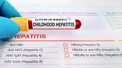 Hasta el momento en México solo se ha registrado una muerte por hepatitis aguda